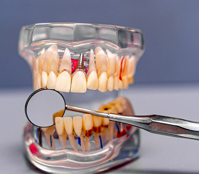 Dental Implants Dental Implants